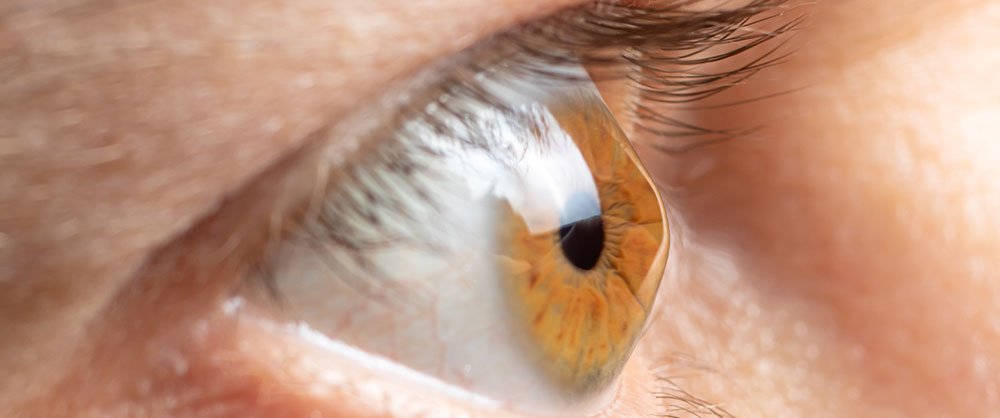 keratokonus ameliyatı